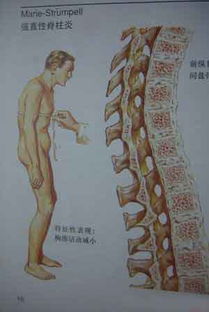 安徽省人大张勇专家教强直性脊柱炎患者如何分期.