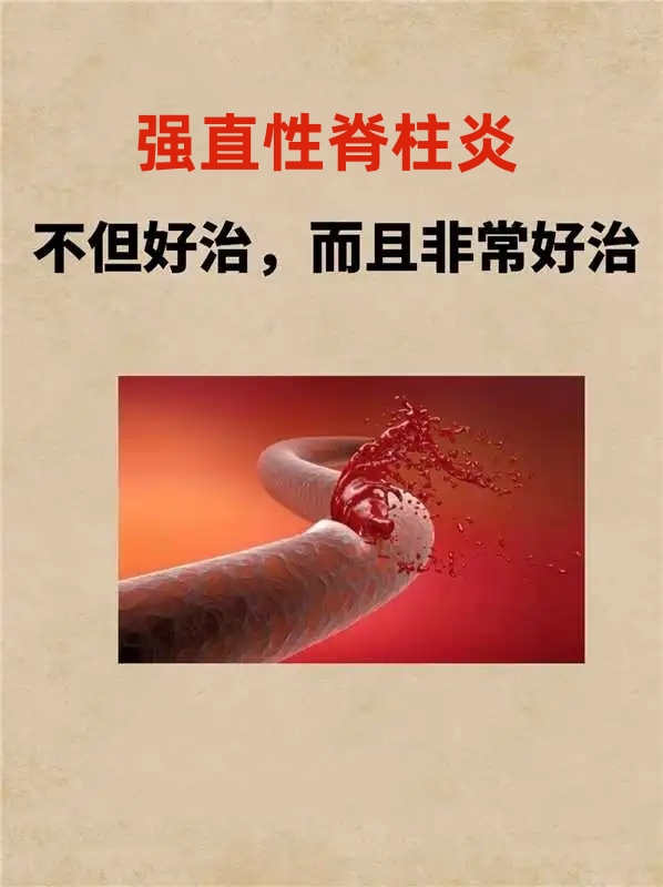 强直性脊柱炎,手术能否"一劳永逸"地解决呢?_腾讯新闻