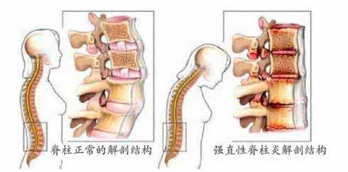 北京强直性脊柱炎就咨询--侯丽萍