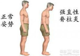 强直性脊柱炎有哪些保守治疗方法