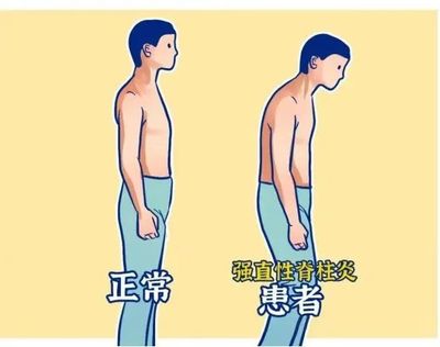 歌手李宇春自曝患有强直性脊柱炎,这病到底有多可怕?