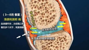 强直性脊柱炎患者千万别 秋冻 ,勿让秋季成为病情 帮凶