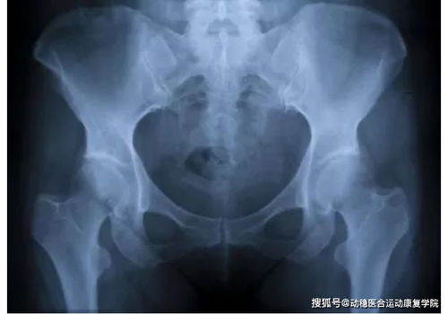 强直性脊柱炎的影像学表现及训练方法