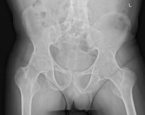 关节置换治疗强直性脊柱炎