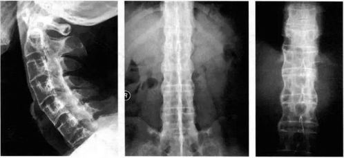 nsaids在强直性脊柱炎治疗中的应用