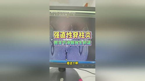 强直性脊柱炎,髋关节滑膜增生积液,治疗宜强