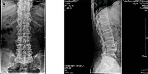病例分享:这真的是强直性脊柱炎吗?_健康_网