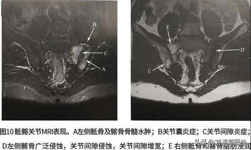 免疫相关不良妊娠答疑解惑56 脊柱关节炎 强直性脊柱炎等