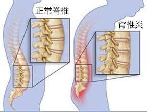 困扰周杰伦多年的强直性脊柱炎,有了新的研究突破