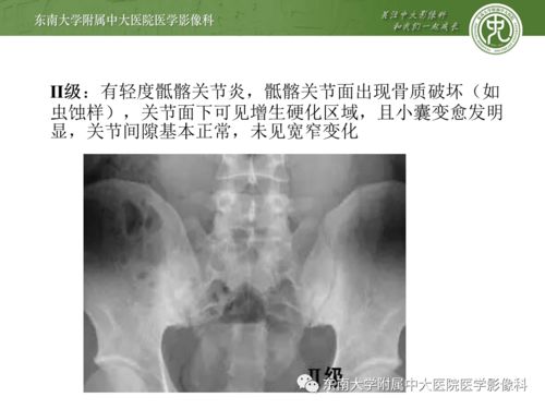 2020.10.09 肌骨系统疾病 强直性脊柱炎