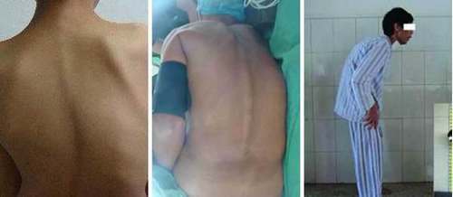 强直性脊柱炎中期症状:脊柱僵硬