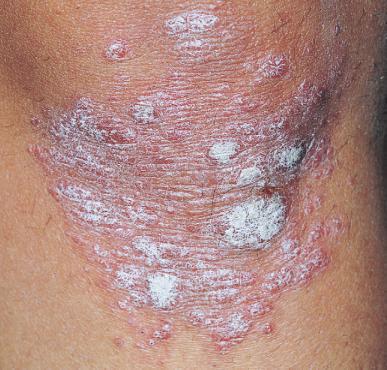 hla b27阳性强直性脊柱炎患者的一级亲属会发病吗 原创