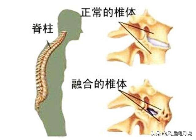 强直性脊柱炎只要治好骨病就可以了吗?_风湿闰月说_2020年05月22日_微头条-今日头条