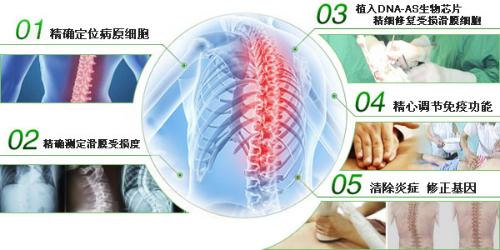 广州强直性脊柱炎医院