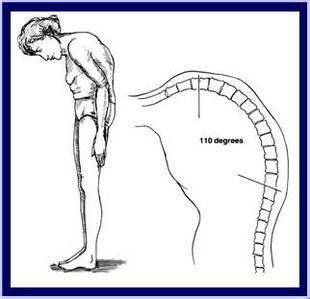 强直性脊柱炎的定义、诊断及治疗知识普及