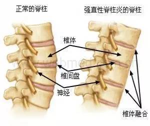不可小觑的强直性脊柱炎