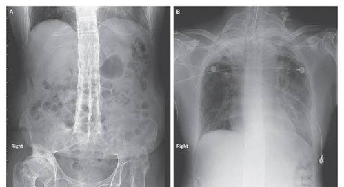 强直性脊柱炎能活多久