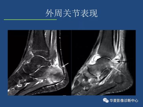 强直性脊柱炎影像诊断和鉴别诊断