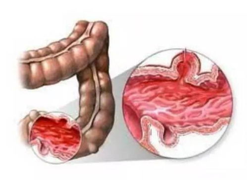 患上强直性脊柱炎就是等死吗 强直影响寿命的真正原因是什么