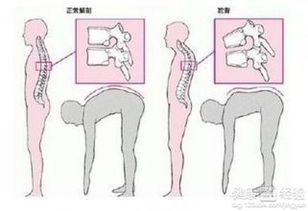 强直性脊柱炎吃什么药好