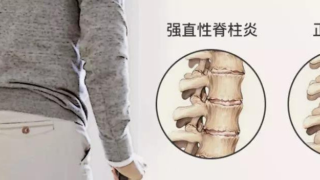 有一种自身免疫性疾病叫强直性脊柱炎,您了解它吗?如何治疗?