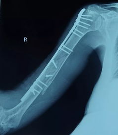 天津医大二院多学科合作成功为重度强直性脊柱炎患者进行多处骨折手术