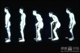 患有腰脱和强直性脊柱炎怎么治疗