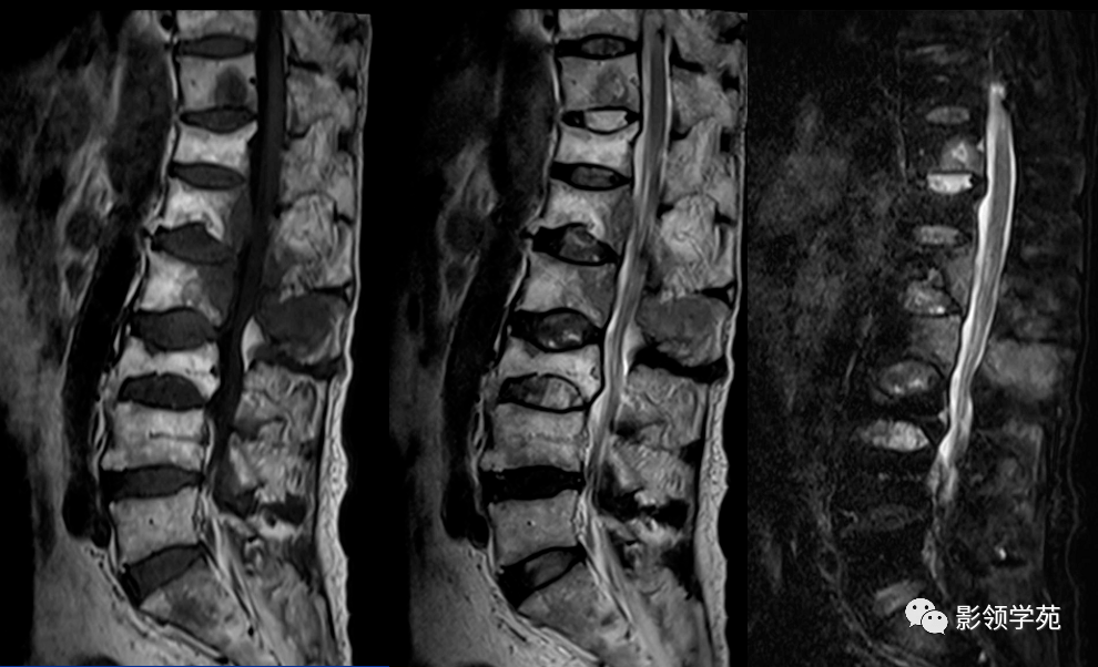 强直性脊柱炎as影像学表现,对as诊断的重要作用!-王建.