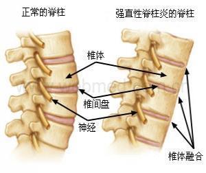强直性脊柱患者炎应进行什么锻炼