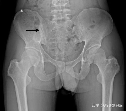 强直性脊柱炎患者x线检查详解