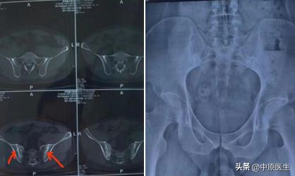 29如果小伙腰疼一年治疗无效,被细心专家发现是强直性脊柱炎