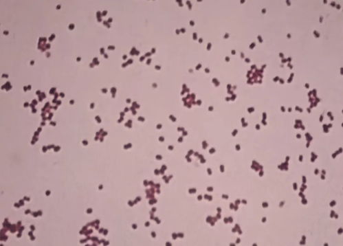 hla b27 检测与强直性脊柱炎