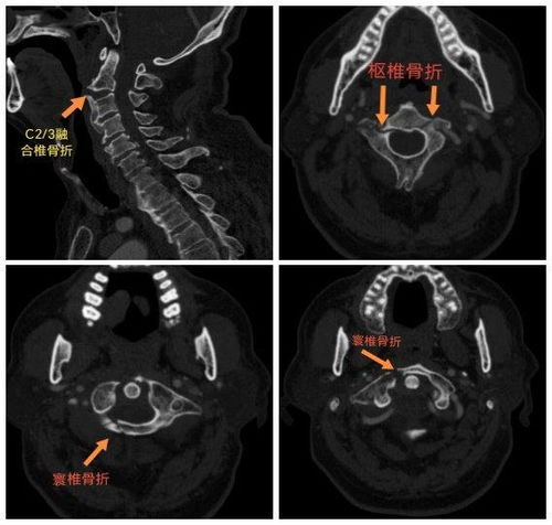 哈医大一院群力骨科精准治疗重塑 生命支柱