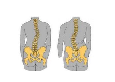 直到现在还困扰&ldquo;周杰伦&rdquo;的一种疾病:强直性脊柱炎,到底是什么来路?(下)