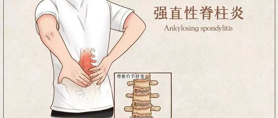 歌手李宇春自曝患有强直性脊柱炎,这病到底有多可怕?