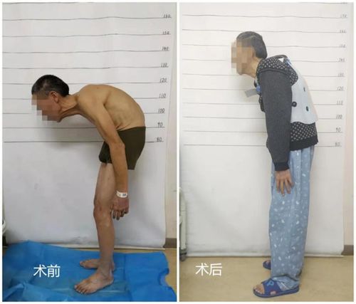 恢复直立人生：山东大学齐鲁医院青岛院区顺利完成高难度脊柱矫形手术助力强直性脊柱炎患者