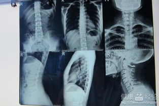 强直性脊柱炎晚期的症状及其影响