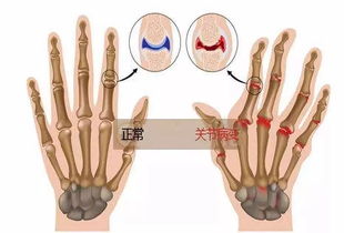 晨僵不只是类风湿的专利，小心骨关节炎和强直性脊柱炎在作怪