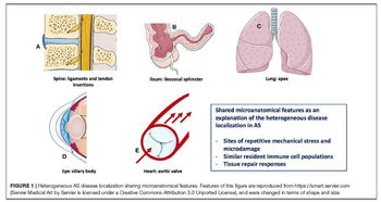 强直性脊柱炎研究进展 从病理机制到治疗策略的全面突破