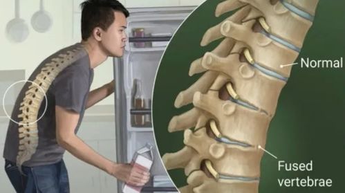 强直性脊柱炎 5种不寻常的强直性脊柱炎症状