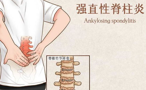 强直性脊柱炎与驼背 病因探究