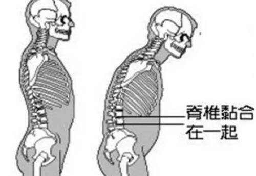 一位医生自述 我与强直性脊柱炎的相遇，以及病后必须注意的这些事项