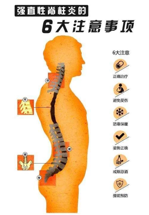 强直性脊柱炎可不可怕？从张嘉译的现状看疾病的真实面貌