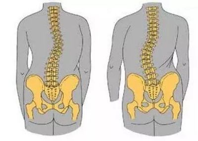 打破遗传宿命 如何科学降低强直性脊柱炎的患病风险